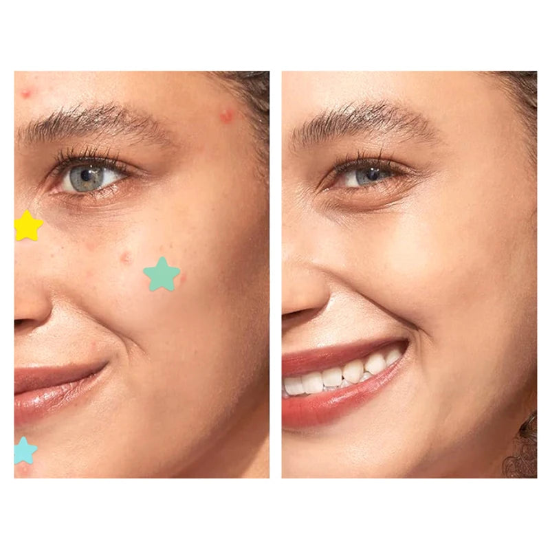 LISM Acne Patch 51pcs Facial Pimples Cover Blemishes